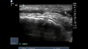 Complete Loss Of Tibialis Anterior Tendon Apearance In Longitudinal View