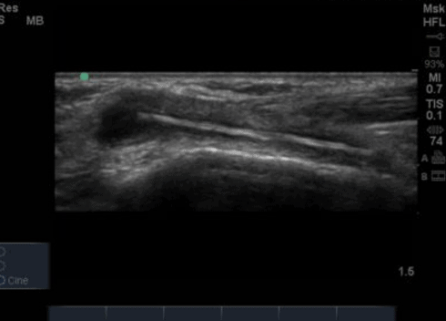 Calcaneal on sale spur ultrasound