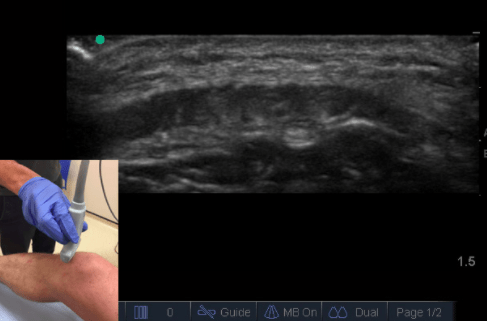 hypoechoic ultrasound