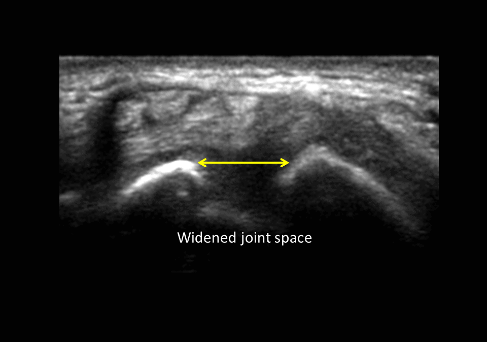 Scapholunate ligament tear