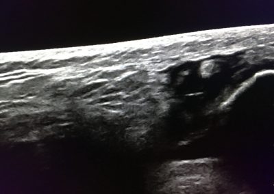 Long axis image of an acute quads tendon rupture