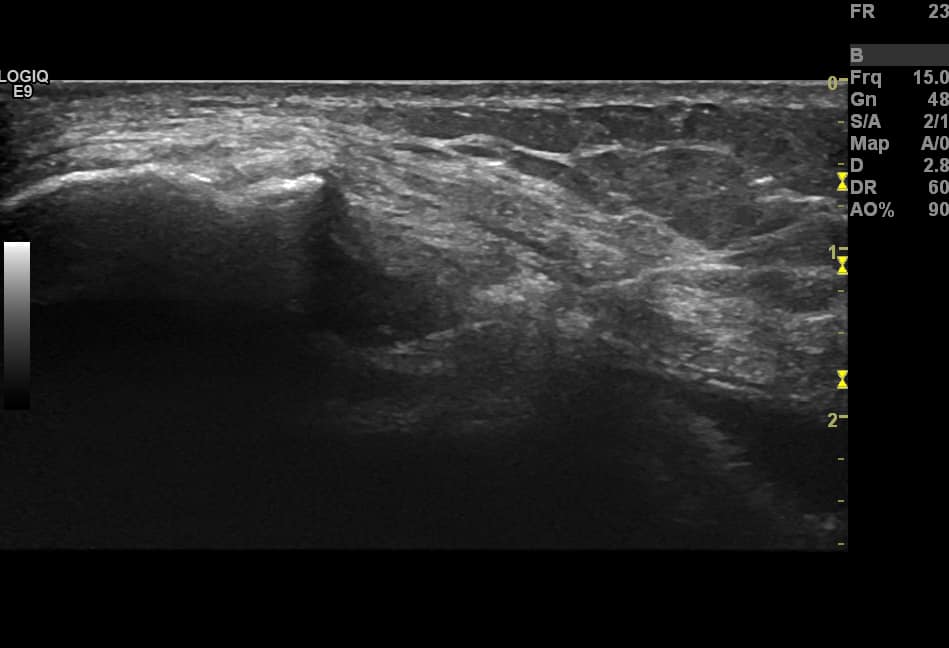 Ultrasound Guided Knee Injection Technique Ultrasound Guided Knee Injection Technique