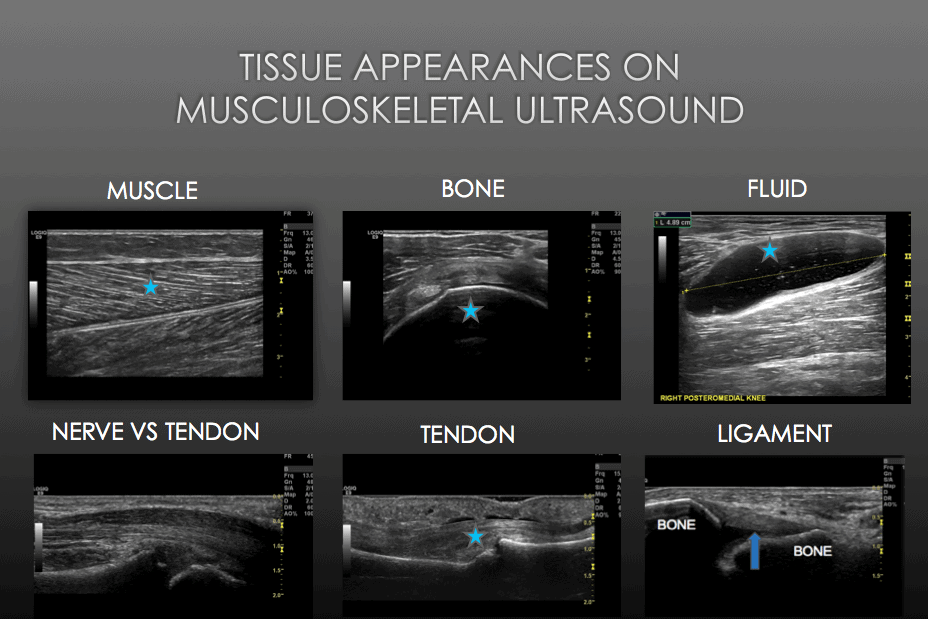 ultrasound tendon extensor tear common tissues shot msk different knee screen bursa leave
