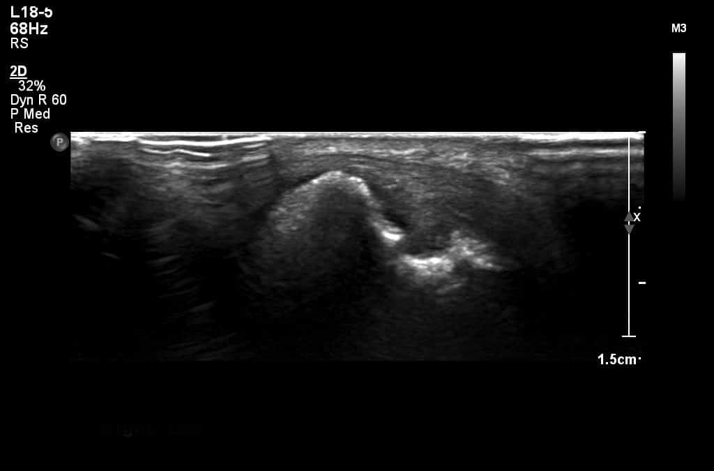 Erosions on ultrasound