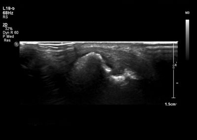 Erosions on ultrasound