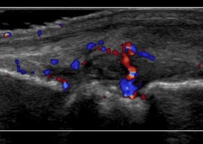 Spondyloarthropathy and ultrasound