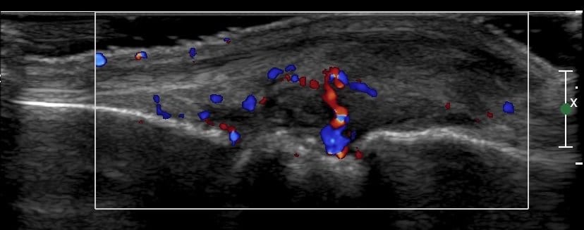 Spondyloarthropathy and ultrasound