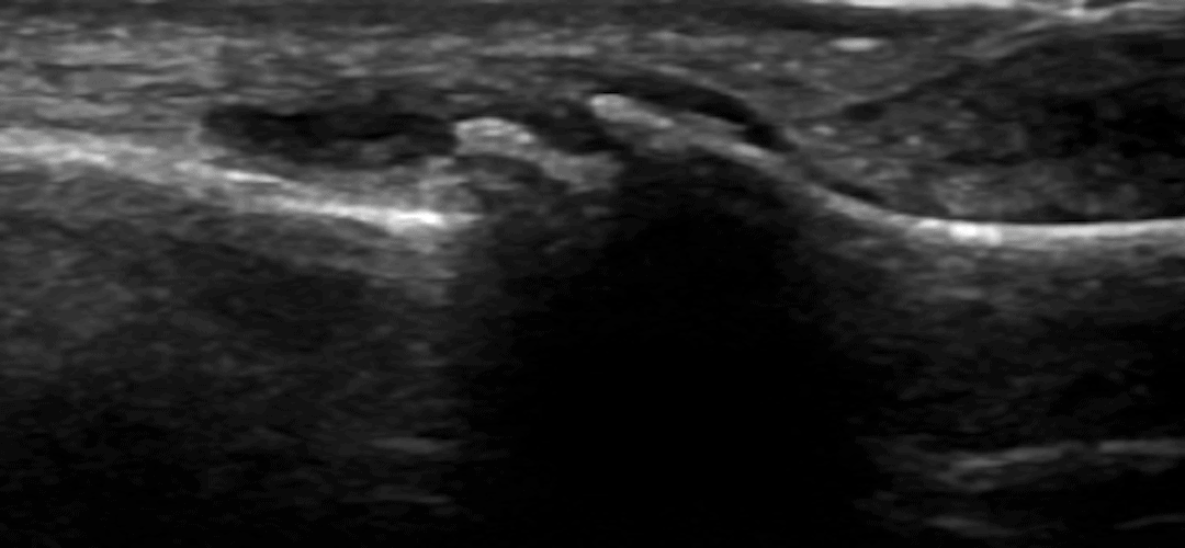 Osteoarthritis and ultrasound