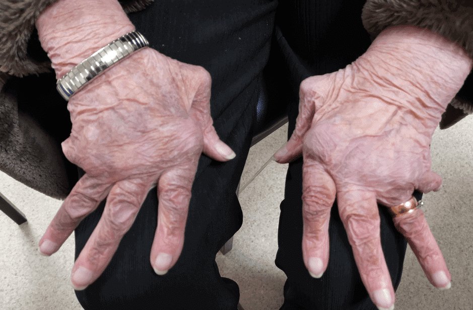 Figure 1 (Consent gained) Characteristic RA hand deformity changes. Significant ulnar deviation, muscle wasting and squaring of the thumbs. 