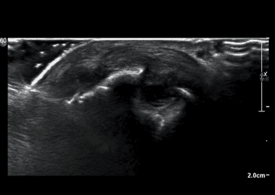 Rheumatoid and Ultrasound