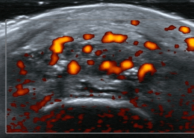 Enthesitis and ultrasound