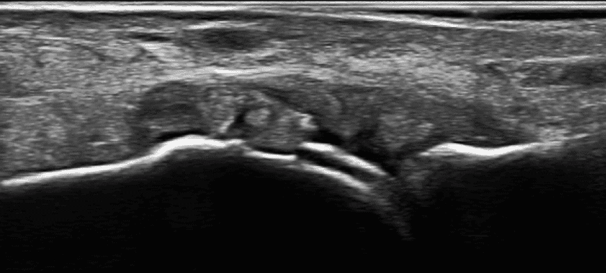Figure 1 Longitudinal view of the MCPJ demonstrating double contour sign and synovial hypertrophy 