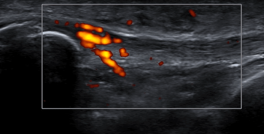 Figure 2 Longitudinal view of the infra-patellar tendon demonstrating doppler signal within the tendon and gouty tophus in the middle of the tendon