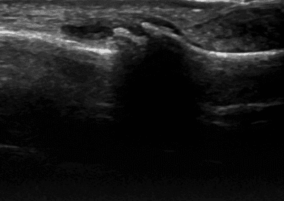 Osteophytes on ultrasound