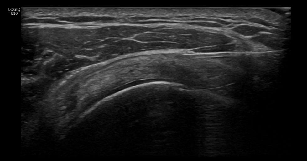 Subacromial subdeltoid bursa injection transverse approach